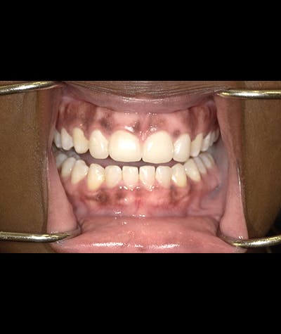 Porcelain Veneers Before & After Gallery - Patient 96909642 - Image 1