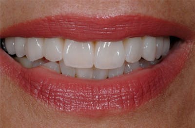 Porcelain Veneers Before & After Gallery - Patient 108774146 - Image 1