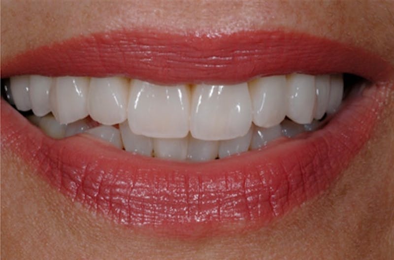 Porcelain Veneers Before & After Gallery - Patient 108774146 - Image 1