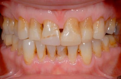 Porcelain Veneers Before & After Gallery - Patient 108774146 - Image 2