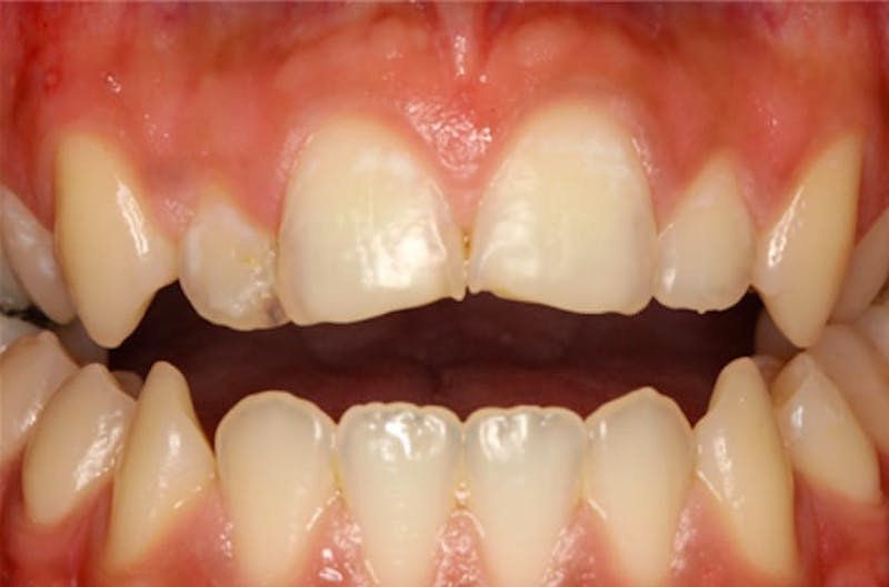 Porcelain Veneers Before & After Gallery - Patient 108774498 - Image 2