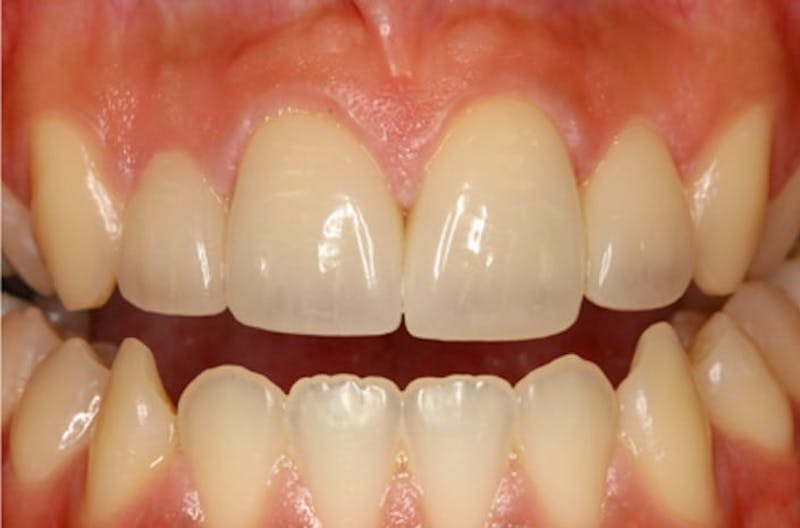 Porcelain Veneers Before & After Gallery - Patient 108774498 - Image 1