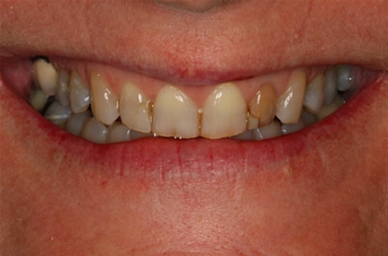 Porcelain Veneers Before & After Gallery - Patient 108774499 - Image 2