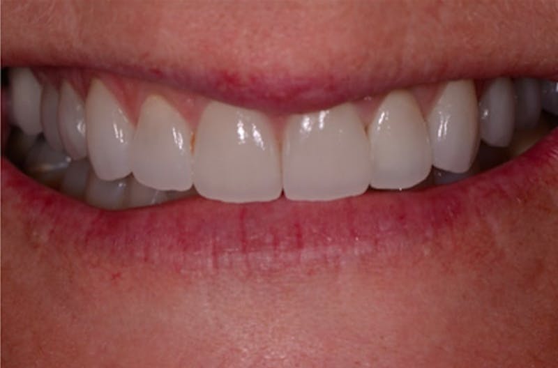 Porcelain Veneers Before & After Gallery - Patient 108774499 - Image 1