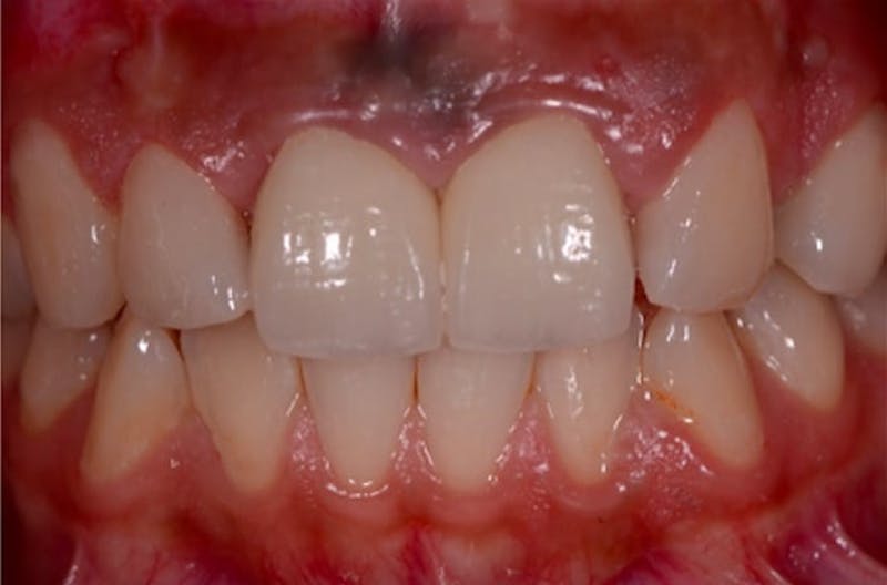 Porcelain Veneers Before & After Gallery - Patient 108774500 - Image 1