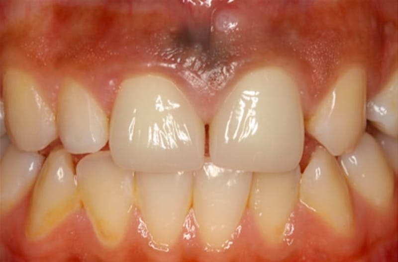 Porcelain Veneers Before & After Gallery - Patient 108774500 - Image 2