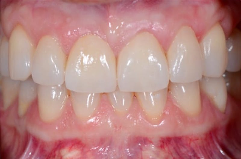 Porcelain Veneers Before & After Gallery - Patient 108774501 - Image 1