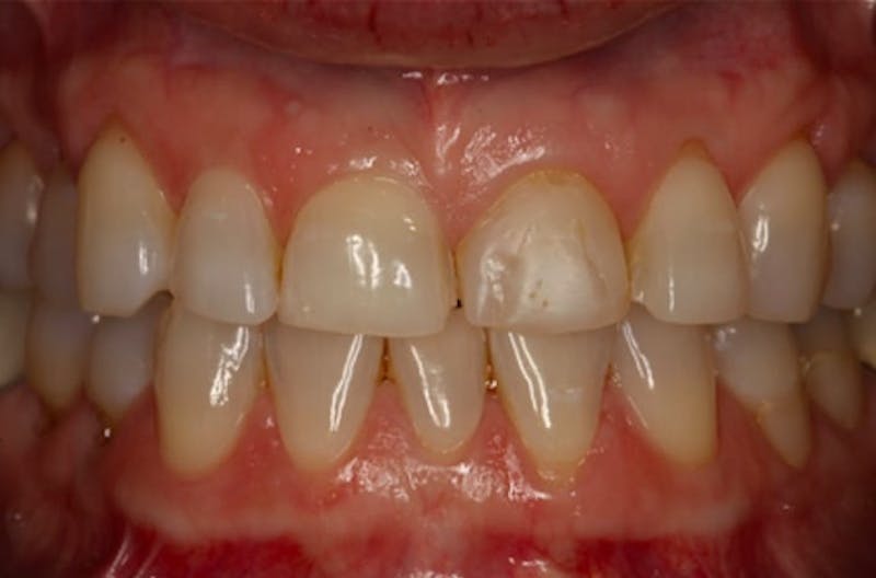 Porcelain Veneers Before & After Gallery - Patient 108774501 - Image 2