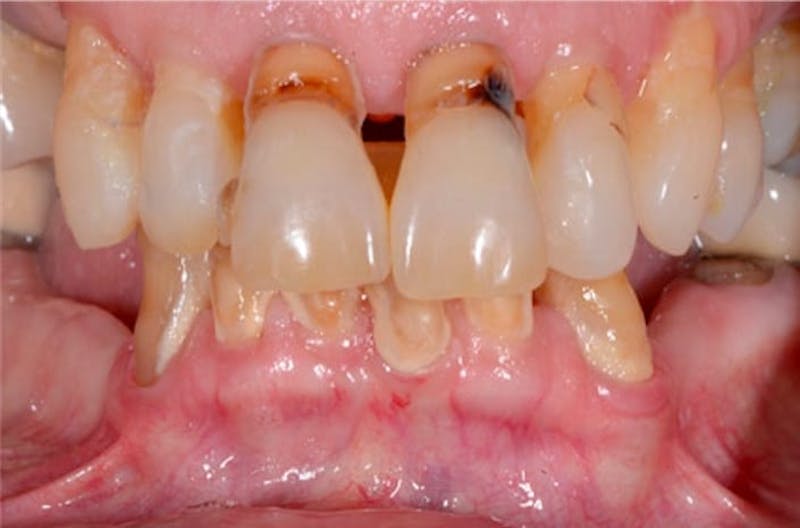 All-on-Four Implants Before & After Gallery - Patient 108811264 - Image 2