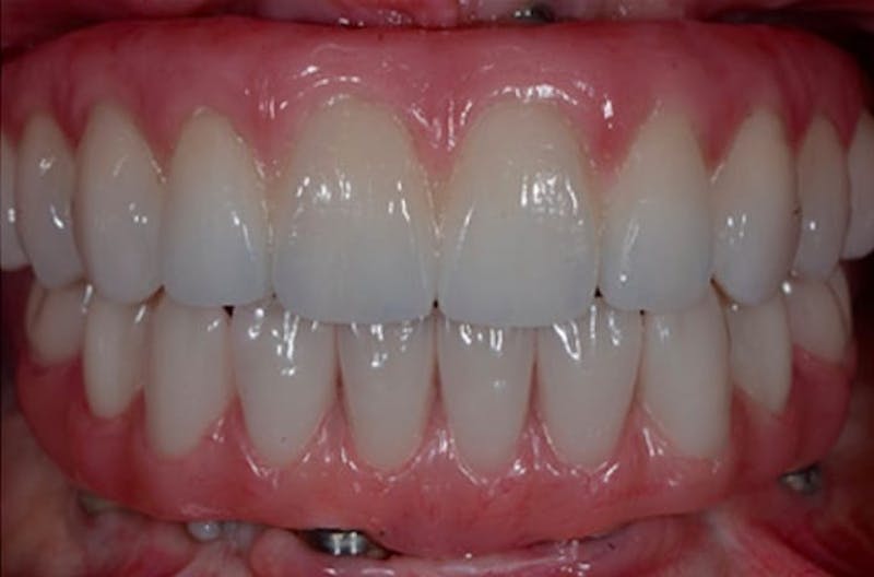 All-on-Four Implants Before & After Gallery - Patient 108811264 - Image 1