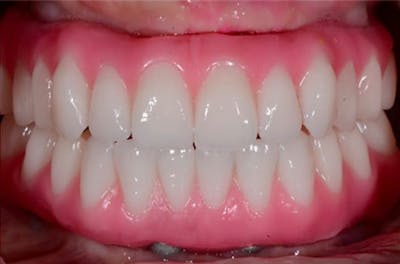 All-on-Four Implants Before & After Gallery - Patient 108811265 - Image 1