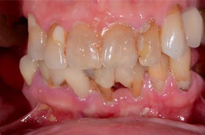 All-on-Four Implants Before & After Gallery - Patient 108811265 - Image 2