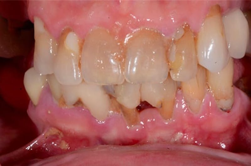 All-on-Four Implants Before & After Gallery - Patient 108811265 - Image 2