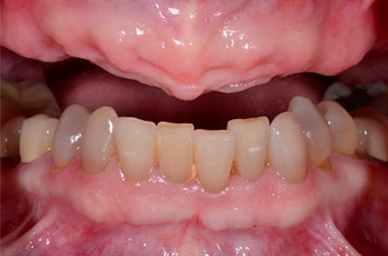 All-on-Four Implants Before & After Gallery - Patient 108811266 - Image 2
