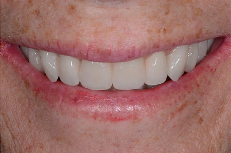 All-on-Four Implants Before & After Gallery - Patient 108811266 - Image 1