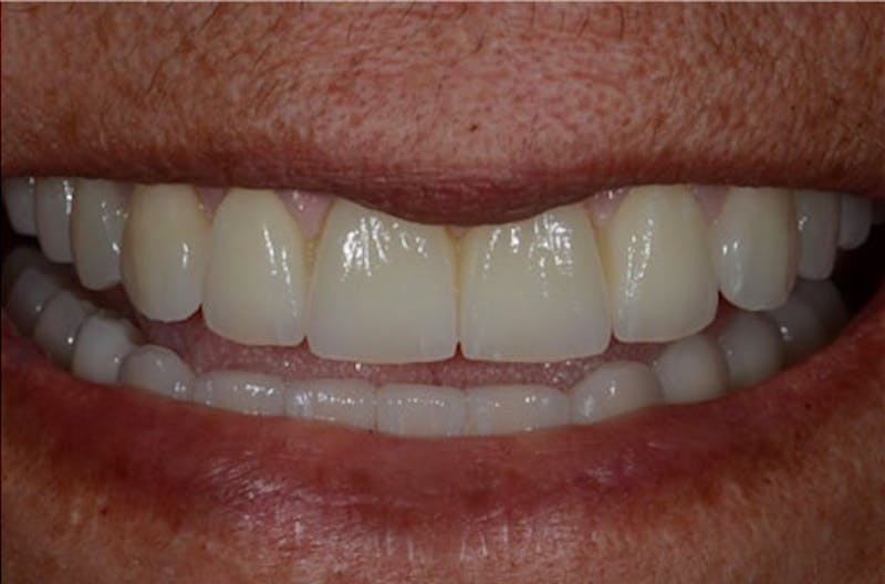 All-on-Four Implants Before & After Gallery - Patient 108811267 - Image 1
