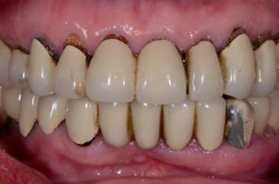 All-on-Four Implants Before & After Gallery - Patient 108811267 - Image 2