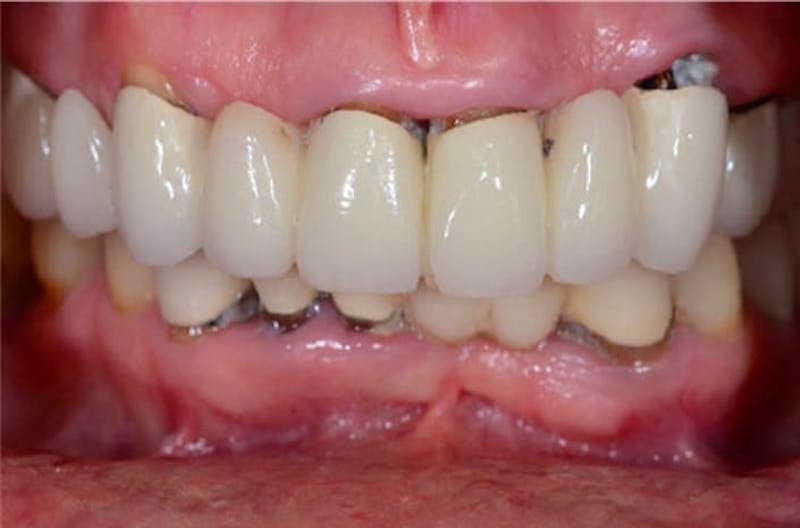 All-on-Four Implants Before & After Gallery - Patient 108811268 - Image 2