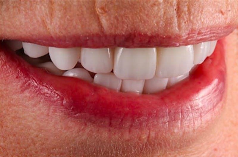 All-on-Four Implants Before & After Gallery - Patient 108811268 - Image 1