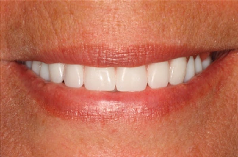 All-on-Four Implants Before & After Gallery - Patient 108811269 - Image 1