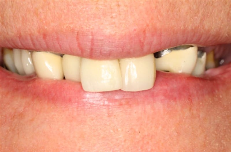 All-on-Four Implants Before & After Gallery - Patient 108811269 - Image 2