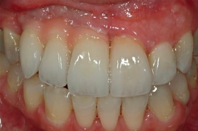 Dental Implants Before & After Gallery - Patient 108811672 - Image 1