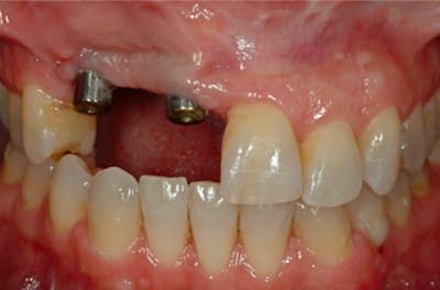 Dental Implants Before & After Gallery - Patient 108811672 - Image 2