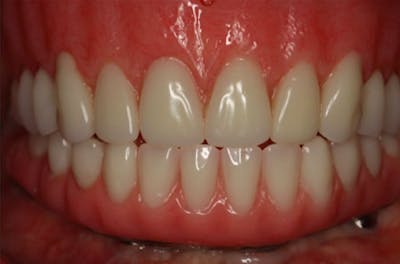 Dental Implants Before & After Gallery - Patient 108811673 - Image 1