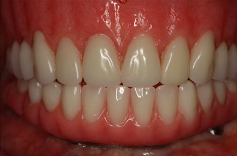 Dental Implants Before & After Gallery - Patient 108811673 - Image 1