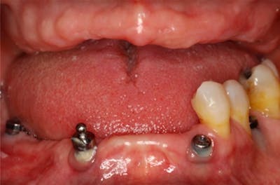 Dental Implants Before & After Gallery - Patient 108811673 - Image 2