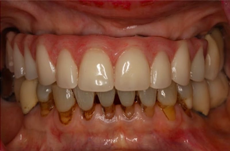 Dental Implants Before & After Gallery - Patient 108811674 - Image 1