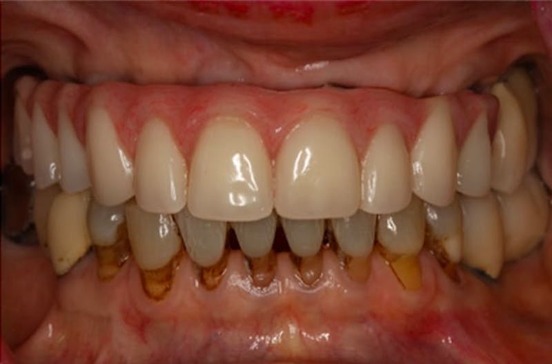 Dental Implants Gallery - Patient 108811674 - Image 1