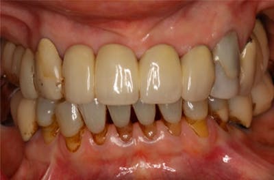 Dental Implants Before & After Gallery - Patient 108811674 - Image 2