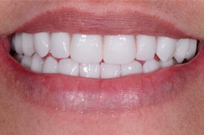 Dental Implants Before & After Gallery - Patient 108811675 - Image 1