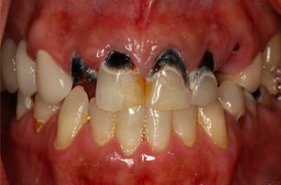 Dental Implants Before & After Gallery - Patient 108811675 - Image 2