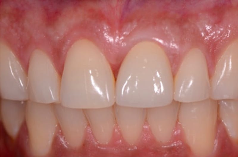 Dental Implants Before & After Gallery - Patient 108811676 - Image 1