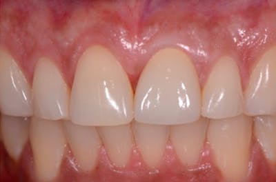 Dental Implants Before & After Gallery - Patient 108811676 - Image 1