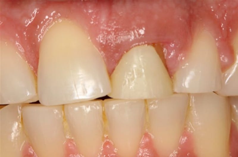 Dental Implants Before & After Gallery - Patient 108811676 - Image 2