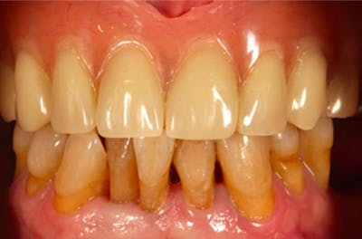 Revision Dental Implants  Before & After Gallery - Patient 108811753 - Image 2