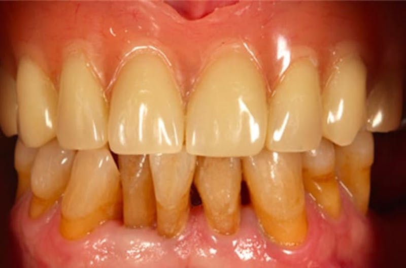 Revision Dental Implants  Before & After Gallery - Patient 108811753 - Image 2
