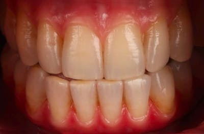 Revision Dental Implants  Before & After Gallery - Patient 108811753 - Image 1