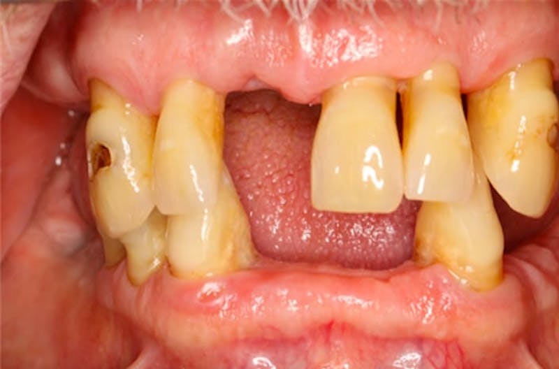 Revision Dental Implants  Before & After Gallery - Patient 108811754 - Image 2