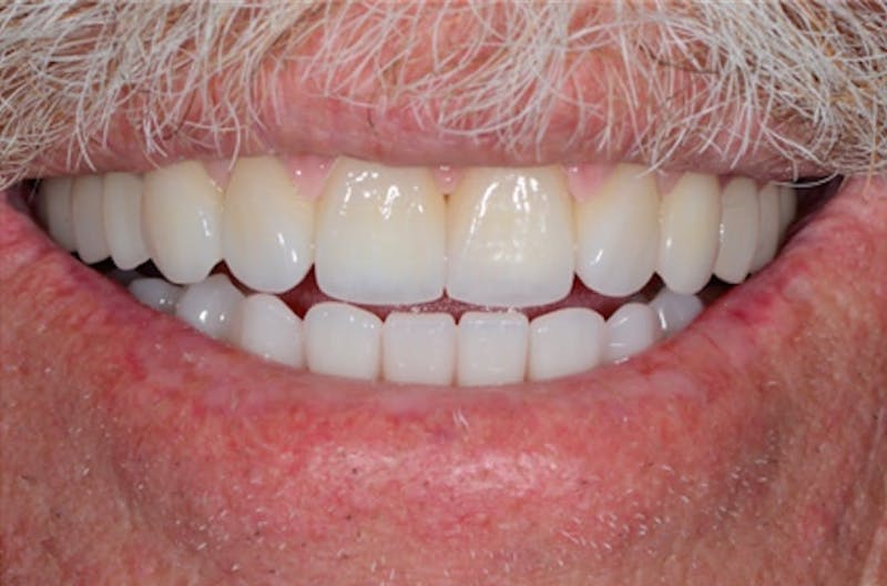 Revision Dental Implants  Before & After Gallery - Patient 108811754 - Image 1