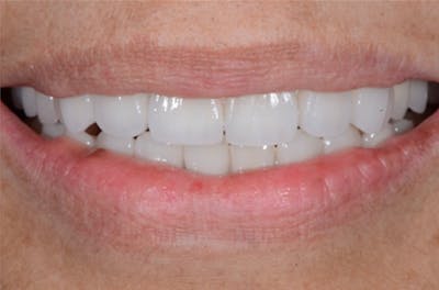 Revision Dental Implants  Before & After Gallery - Patient 108811755 - Image 1