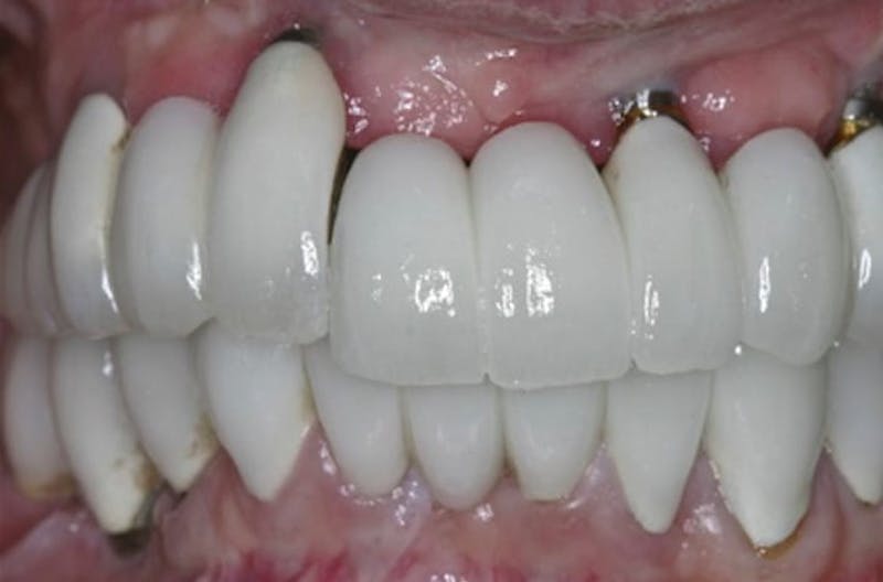 Revision Dental Implants  Before & After Gallery - Patient 108811755 - Image 2