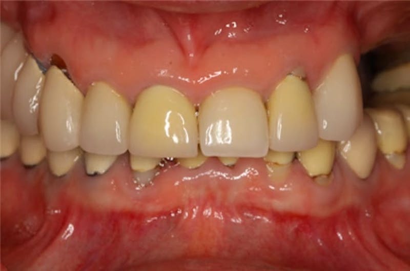 Revision Dental Implants  Before & After Gallery - Patient 108811756 - Image 2