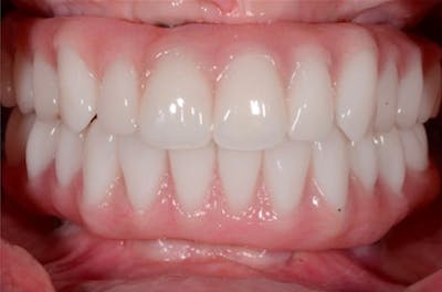 Revision Dental Implants  Before & After Gallery - Patient 108811756 - Image 1