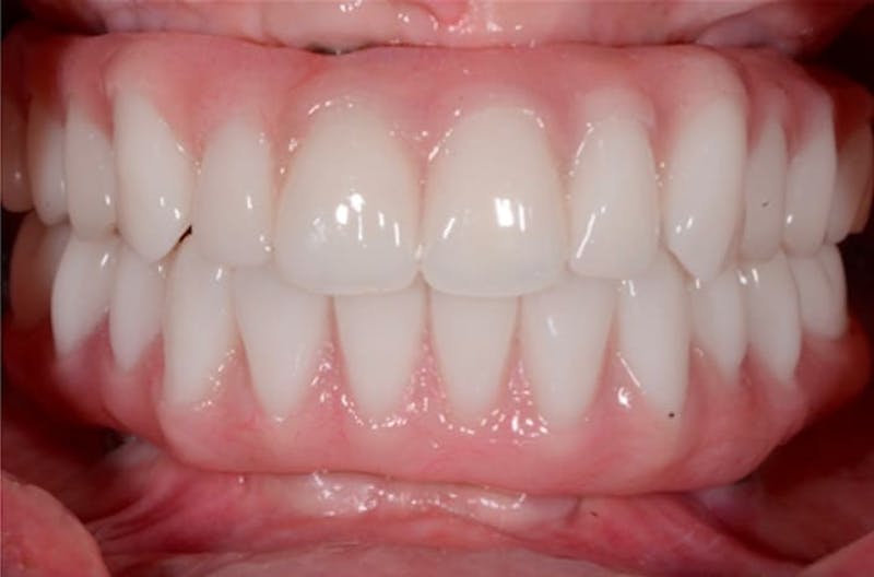 Revision Dental Implants  Gallery - Patient 108811756 - Image 1