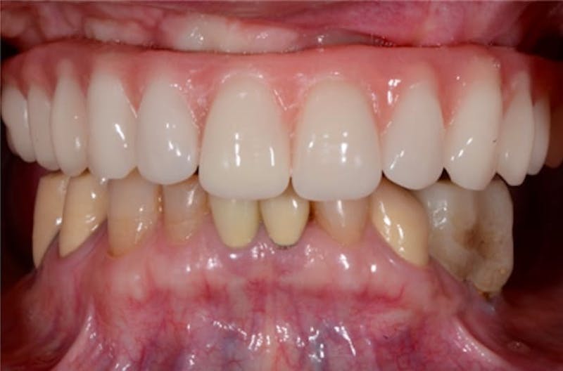 Revision Dental Implants  Before & After Gallery - Patient 108811757 - Image 1