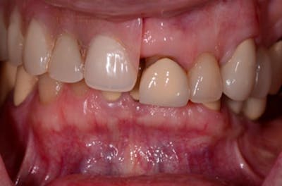 Revision Dental Implants  Before & After Gallery - Patient 108811757 - Image 2
